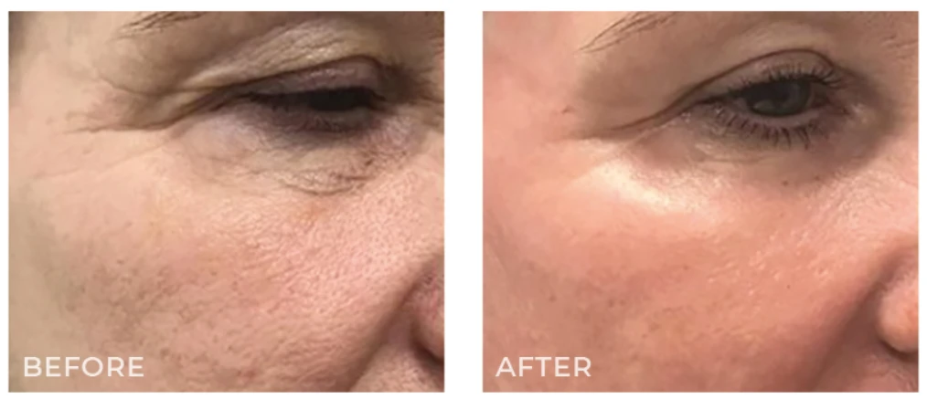 hifu-3d-dermaforce-8.webp