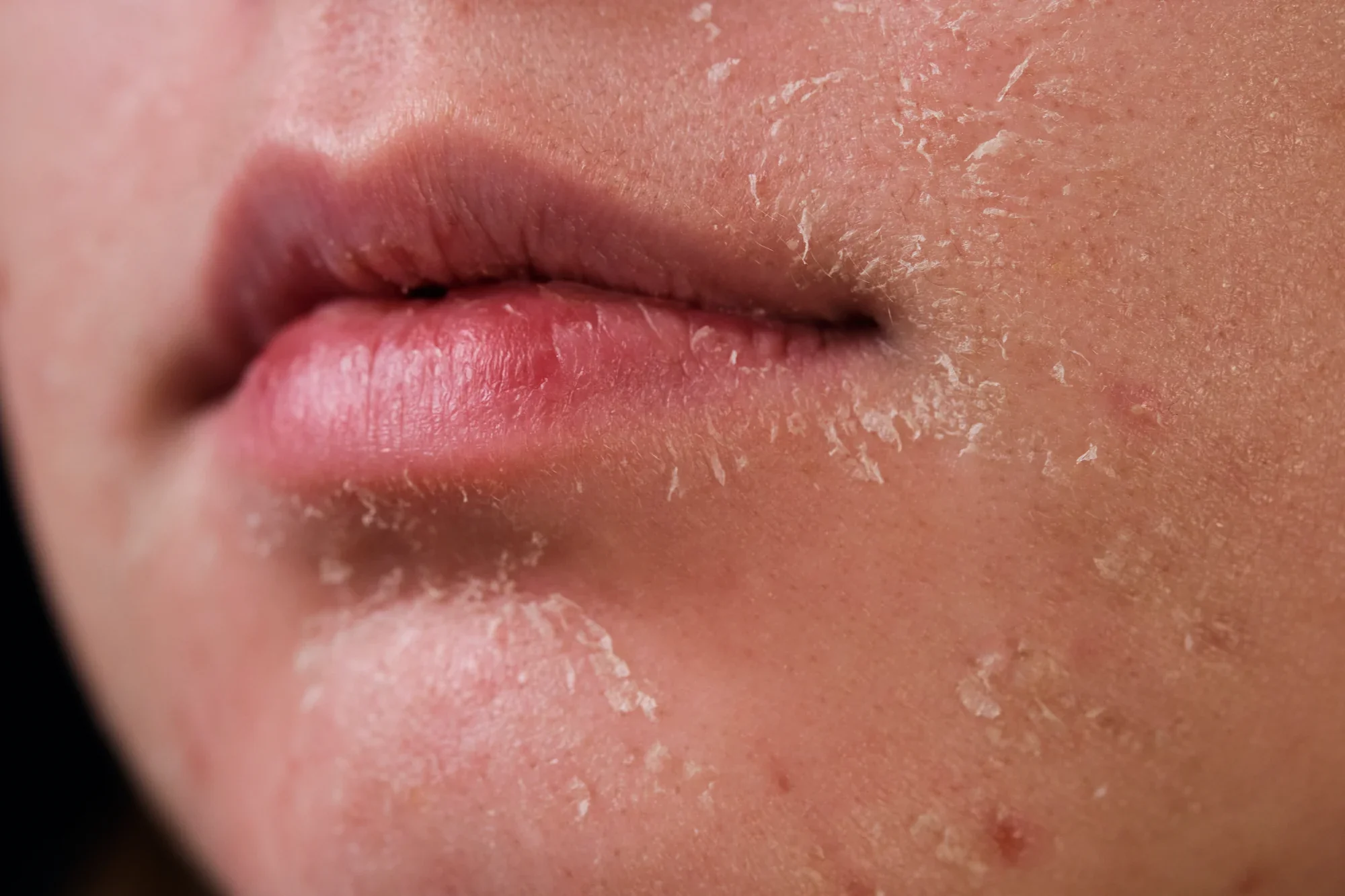 Dry-Skin-Stock-Photo.webp