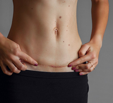 gros-plan-du-ventre-de-femme-avec-une-cicatrice-d-une-taille-de-cesarienne.jpg