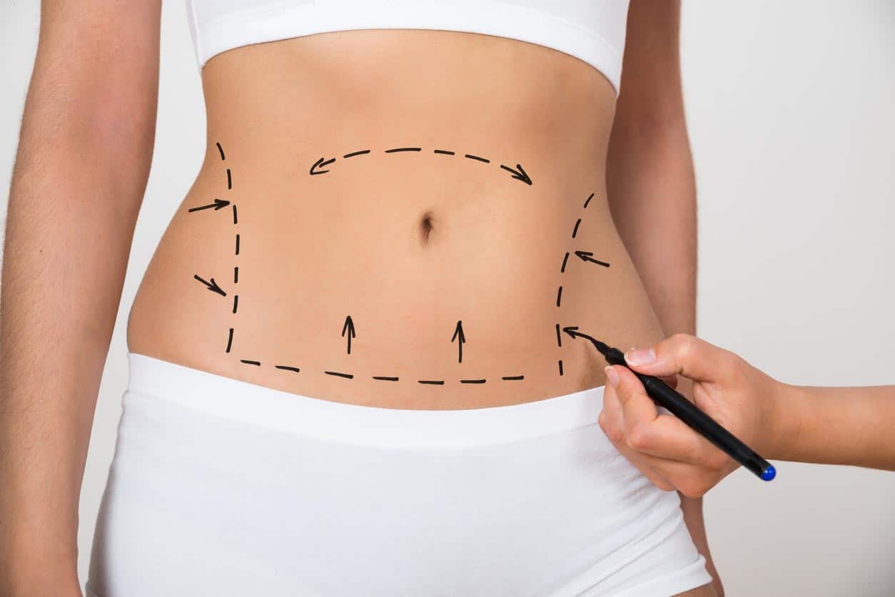 Abdominoplastie en Tunisie : technique, tarifs et séjour tout-compris à Tunis
