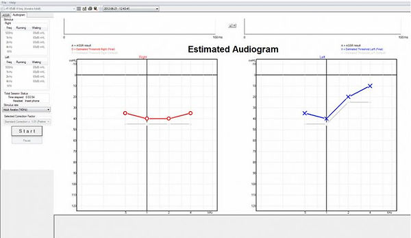ASSR ekran Interacoustics CE Chirp ABR E