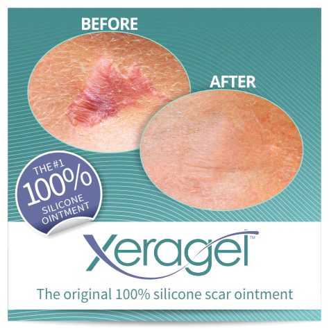 Thumbnail: Xeragel Scar Ointment