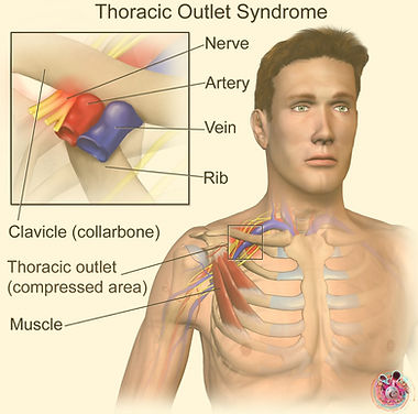 Thoracic outlet syndrome Cardiff