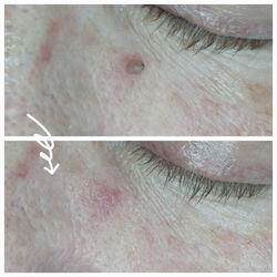 Advanced Electrolysis