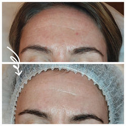 Microneedling