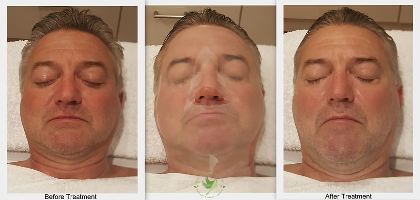 Lifting facial1-ink.jpeg