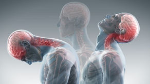 Whiplash Injury