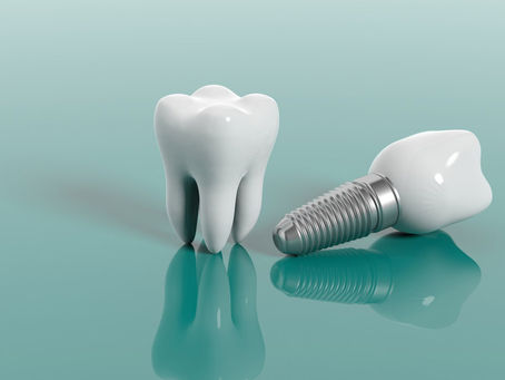 Los Implantes Dentales: Siempre hay una solución !