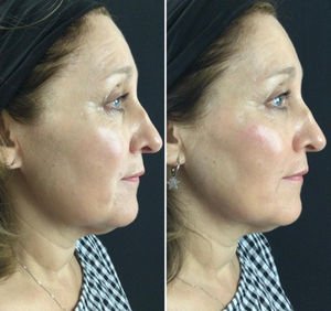 Dermal Filler