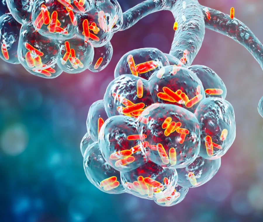 polmonite-da-legionella_900x760.webp