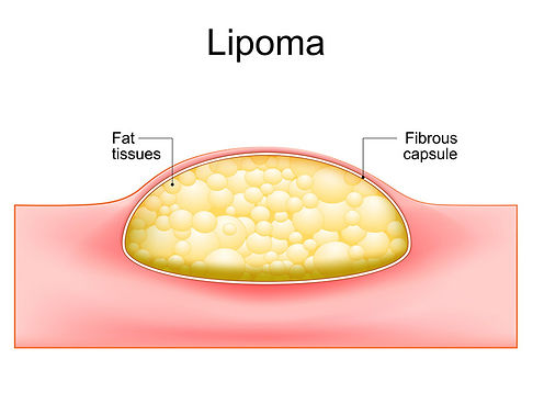 lipoma-img1-2.jpg