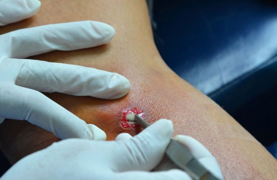 Abscesso recorrente como causa de infecção de pele