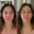 After Session 1 & 2: Results continue to improve, lips are fuller, face has shortened, brows lifted, face more symmetrical.