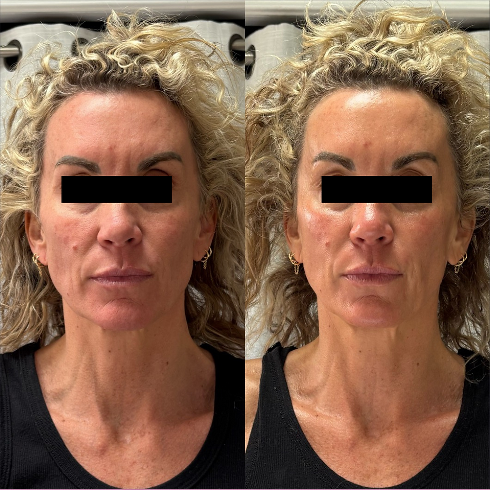Before and After 1 Session