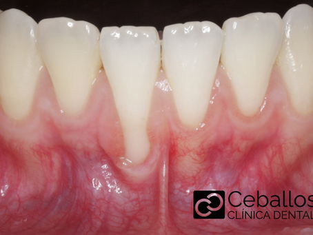 caso de tratamiento de retraccion de encias en malaga con periodoncista