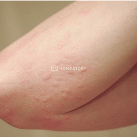 Bị Nổi Mề Đay Nên Xông Lá Gì? Top Lá Xông Tự Nhiên Hiệu Quả