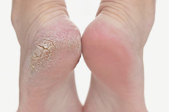 Soin anti-callosités pieds, yumifeet, condé sur noireau, vire, flers