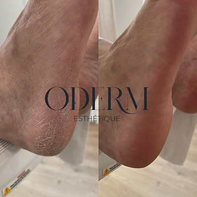 soin pied yumifeet, anti-callosités condé sur noireau, flers, vire