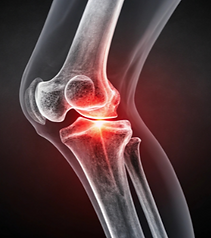 Hyaluronfiller für Knie