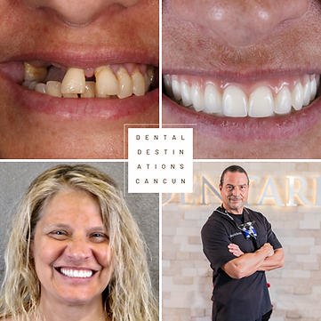 Dental Destinations Cancun ALLON4.PNG