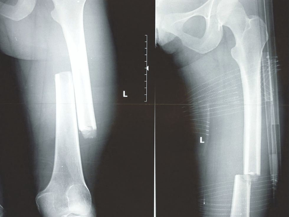 Thumbnail: CT-6 LEG TRACTION SPLINT TACTICAL/MILITARY