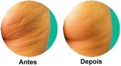 NOVA terapia anti celulite