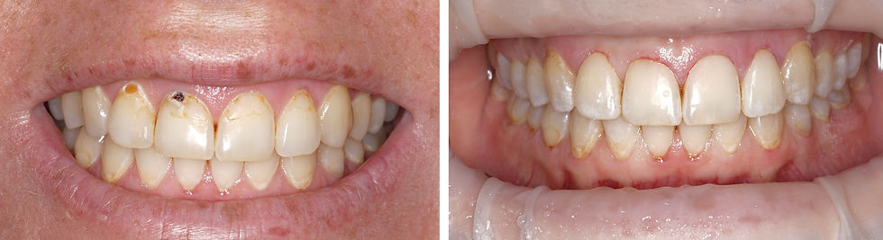 Unsightly fillings on front teeth
