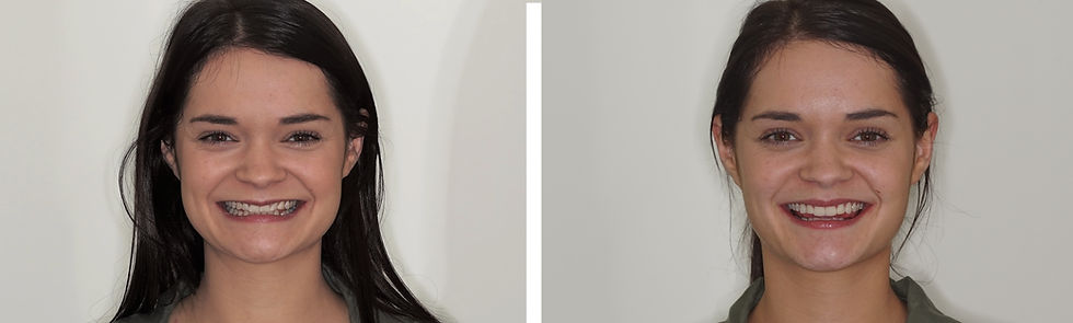 Old composite veneers