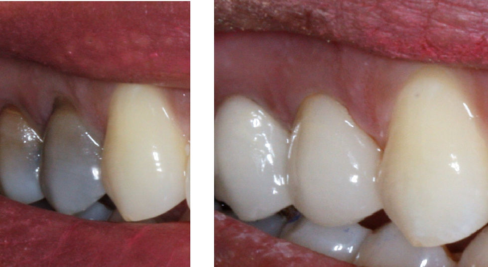 Weak and discolored teeth