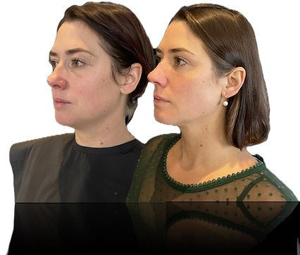 Nemasculpt Endolift jawline sculpting do