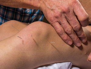 Benefits of Dry Needling