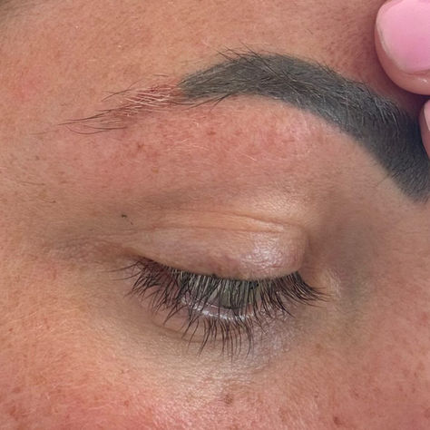 Does Laser Tattoo Removal Scar? Myths vs Facts