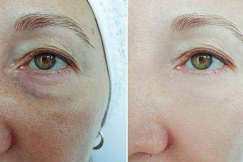 Lumi Eyes Mesotherapy.jpeg