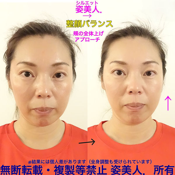シルエットで小顔矯正の施術を受けた女性のビフォーアフター画像 リフトアップしてあご周りやフェイスラインもスッキリした印象になりました 筋膜リリース 大阪 目 むくみ 食いしばり バランス たるみ おすすめ クーポン