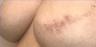 areola before and after.jpg