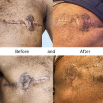 Scar Hyperpigmentation