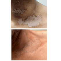 Vitiligo Skin Camouflage