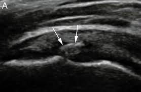 Calcific tendon shoulder tratment shockwave