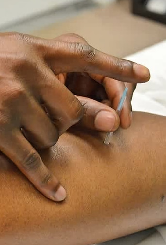 acupuncture for pain