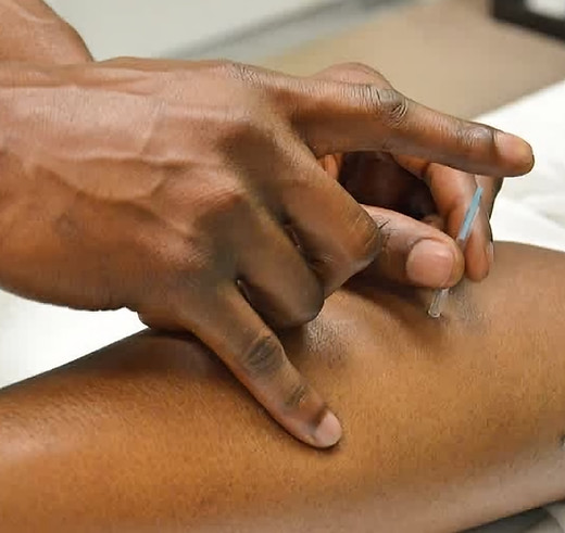 acupuncture for sports injuries