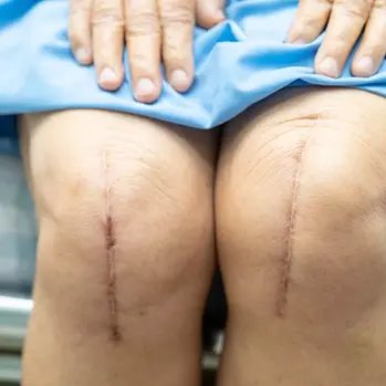 Knee surgery recovery