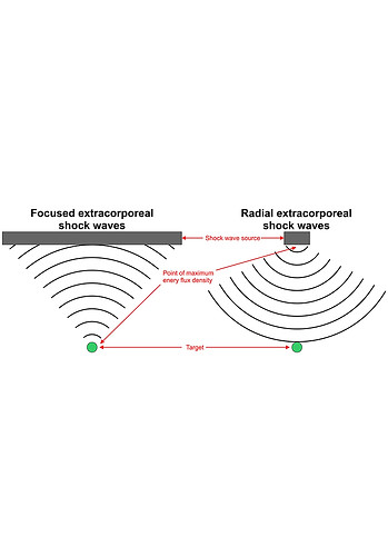 Focused Shockwave Therapy Auckalnd Mechanics.jpg