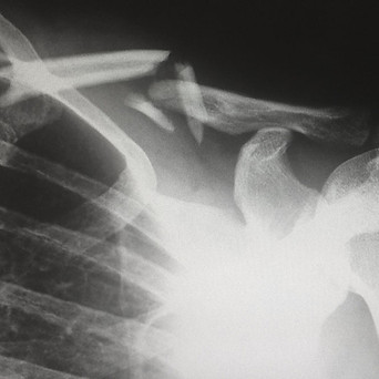 Fracture shockwave tehrapy osteopathy.jpg