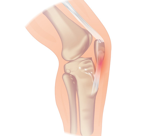 Jumpers knee