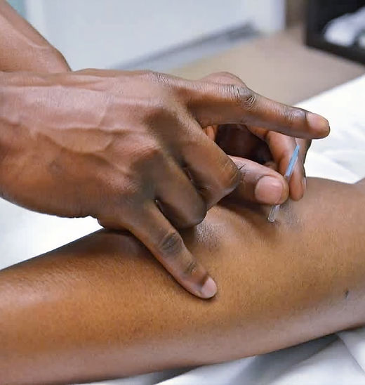 ACC registered Osteopath acupuncture