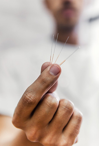 Acupuncture auckland