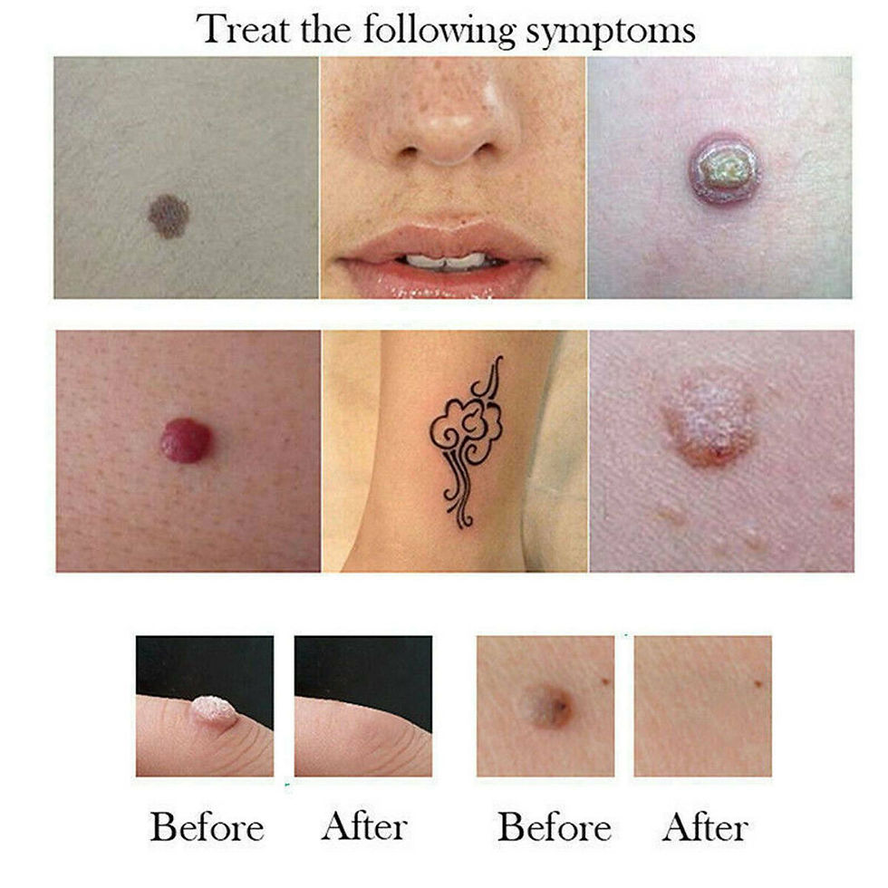 Thumbnail: PORTABLE FIBROPLAST PLASMA PEN