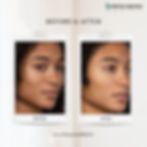 Thumbnail: Dermasky Lactic Acid Peel Kit (with pre peel, neutralizer & brush)