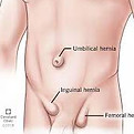 hernias.jpeg