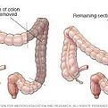 colectomy.jpeg